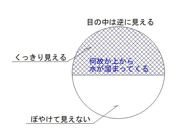 突然の網膜剥離で入院 復帰まで